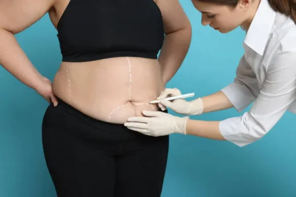 A surgeon marking the abdomen of an overweight woman before abdominoplasty to highlight tummy tuck benefits